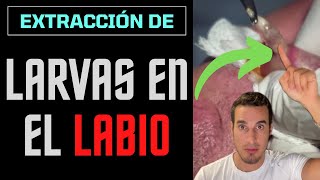 Les extraen LARVAS DE MOSCA de los LABIOS  Parásitos en la BOCA [upl. by Tilden]