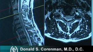 How to Read a MRI of Cervical Nerve Compression  Neck Pain  Colorado Spine Surgeon [upl. by Ecraep]