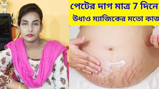 মাত্র 7 দিনে গর্ভকালীন পেটের ফাটা দাগ দূর করার উপায়। Stretch mark removal in bengali [upl. by Eelirol]