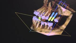 Dental CBCT Scan Demo  Dr Anderkvist Westwood Dental Smiles [upl. by Colleen]