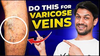 VARICOSE VEINS explained under 10 minutes  Saurabh Bothra Yoga [upl. by Tiemroth]