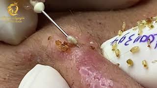 Treatment of blackheads and whiteheads 394  Loan Nguyen [upl. by Hoopen]