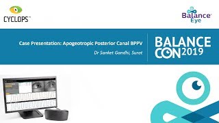 Case presentation Apogeotropic posterior canal BPPV [upl. by Mountfort]