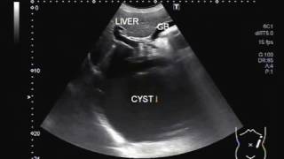 Ultrasound Video showing a large cyst in Liver [upl. by Eeral2]