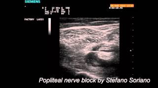 Ultrasound guided popliteal nerve block [upl. by Notlih]