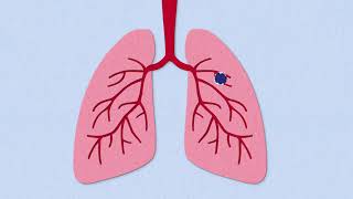 Fibrosis Explained [upl. by Sterrett646]