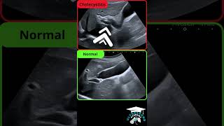 Incipient Cholecystitis Ultrasound Findings [upl. by Lucania847]