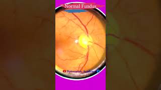 Normal fundus  Normal Retina  Smartphone Fundus Videography  Fundus Photography  Short Video 87 [upl. by Yenetruoc36]