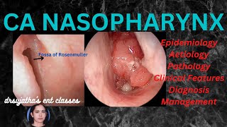 199Nasopharyngeal Carcinoma Part 13 epidemiology aetiologyclinical features nasopharynx [upl. by Alusru9]