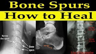 How to Heal Bone Spurs Naturally  Dr Alan Mandell DC [upl. by Brubaker]