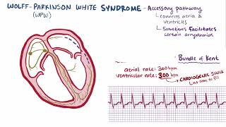 Wolff Parkinson White Syndrome  Osmosis [upl. by Canice]