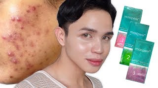 CHEAP amp EFFECTIVE ACNE TREATMENT 17 pesos only  MAXIPEEL MicroExfoliant Cream [upl. by Levitus]