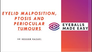 Eyelid malposition ptosis and periocular tumours [upl. by Nefen]