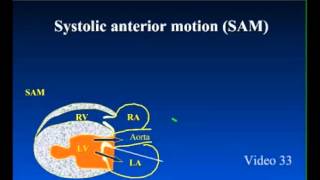 SAM  Systolic Anterior Motion in Feline Cardiomyopathy [upl. by Anavlys]