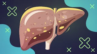 Fatty Liver Disease on the RISE in 2024 Whats Behind the Epidemic [upl. by Rabkin]