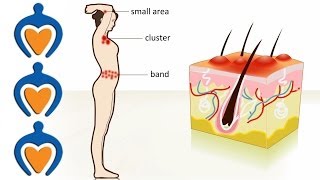 Shingles  The causes symptoms treatment and prevention [upl. by Ihcekn]