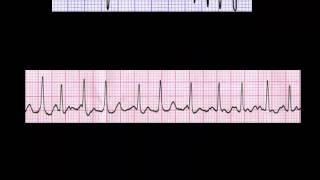 CURSO DE ELECTROCARDIOGRAFIA 24  AUTOEVALUACIÓN SOBRE MEDICIÓN DE FRECUENCIA [upl. by Adnarb365]