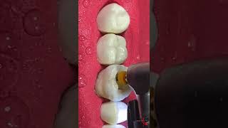 Small Cavity Big DAMAGE rootcanaltreatment [upl. by Nylaj]