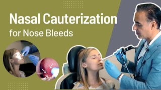 Nasal Cauterization for Nose Bleeds Epistaxis  Nose Bleed Treatment [upl. by Flip113]