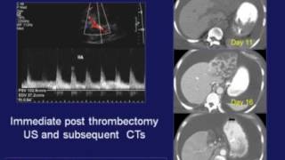 Orthotopic Liver Transplant Hepatic Artery and Portal Vein Complications [upl. by Alleinad]