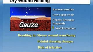 Why Moist Wound Healing [upl. by Cynth]