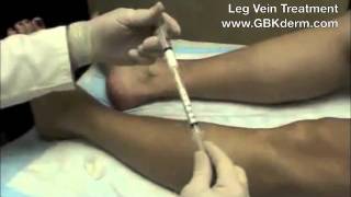 Sclerotherapy  Varicose Vein Treatment  Dr Goldman [upl. by Stanway]