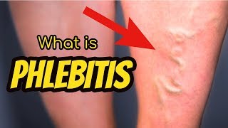 What is Phlebitis [upl. by Tudela]