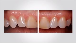 Subgingival Margin Placement [upl. by Teevens]