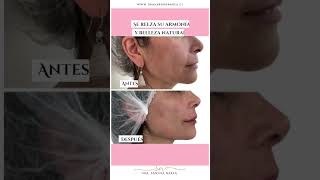 ✨ Perfiloplastia con Acido Hialurónico ✨ [upl. by Ardnusal]