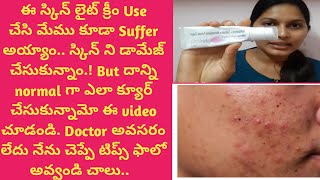 Skin lite Cream sideffects solution in teluguస్కిన్ లైట్ క్రీం use చేసాక ఫేస్ మొత్తం డామేజ్ అయింది😔 [upl. by Carlyn]