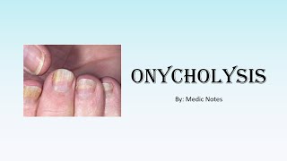 Onycholysis Plummers nail causes and pathophysiology [upl. by Tillio]