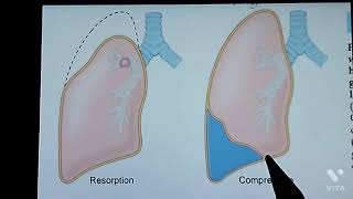 Congenital Anomalies of respiratory system📝📝 easy😎 explanation [upl. by Eiramnna]