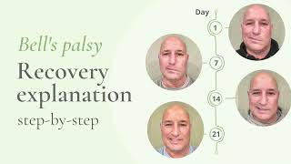 Bells palsy recovery Stepbystep explanation [upl. by Nirek]