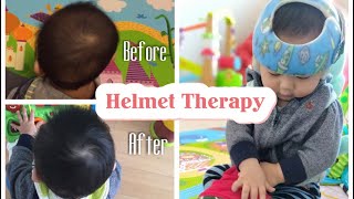 12 Weeks Progress Helmet Therapy For Flat Head SyndromePlagiocephaly [upl. by Hughes]