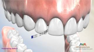 Interproximal Reduction or IPR  Polishing Strip [upl. by Nosreme]