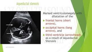 AQUEDUCTAL STENOSISVentriculomegaly A2Z of Ultrasound [upl. by Ocin]