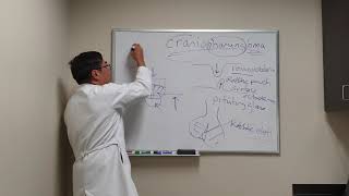 Craniopharyngioma in Neuro ophthalmology [upl. by Winchell]