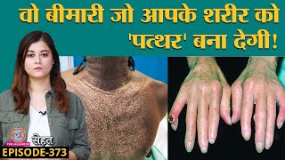 Scleroderma वो बीमारी जिसमें Skin पत्थर जैसी हो जाती है कैसे बचें  Sehat ep 373 [upl. by Ecirtnuahs]