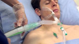 Using Intersurgicals TrachSeal™ closed suction systems [upl. by Karlise825]