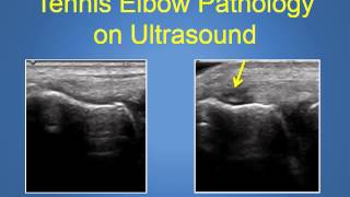 Tennis Elbow Treatment Explained by a Top Phoenix Orthopedic Surgeon 480 2193342 [upl. by Montgomery580]