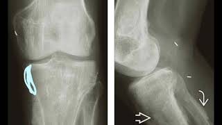 18 HYPERTROPHIC OSTEOARTHROPATHY [upl. by Kenlee]