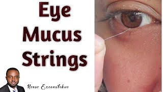 Eye Mucus Strings  Mucus Fishing Syndrome  Causes and Treatment [upl. by Bernetta]