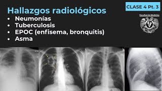 043  Neumonía TB EPOC Enfisema Bronquitis Bronquiectasias Asma [upl. by Enyar]