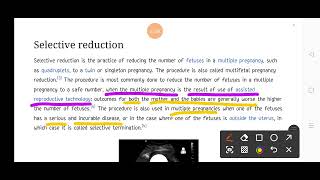 selective Reduction  Obstetrics ✓HINDI EXPLAINED ✓ [upl. by Ehc634]