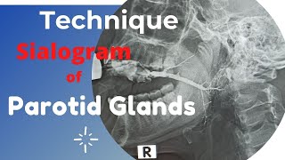 Sialogram of Parotid gland Ep53  Technique of parotid gland  procedure of parotid gland [upl. by Nilat]