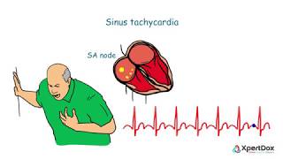 Sinus Tachycardia  A condition with fasterthanusual heart rhythm [upl. by Otha611]