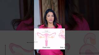 क्या Bicornuate uterus में Pregnancy हो सकती है sonaamedihub drsonalparihar gynaecologist [upl. by Nally]