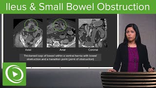 Bowel Obstruction and Ileus Ileus amp Small Bowel Obstruction – Radiology  Lecturio [upl. by Steffin]