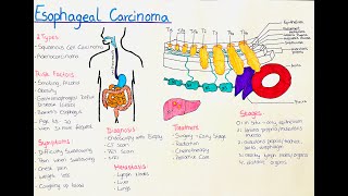 Esophageal Cancer  What you need to know [upl. by Juliet]