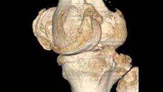 iradka 3d reconstruction from ct data human knee joint Radiologie Karlsruhe [upl. by Ffirahs]